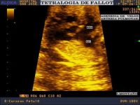 Diagnóstico prenatal de tetrología de Fallot. Serie de casos clínicos.